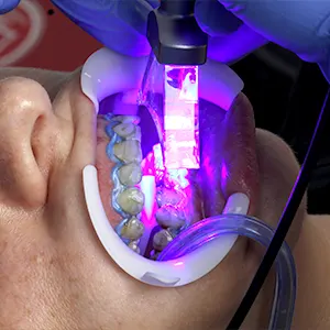 Img-Servicios-Blanqueamiento-2